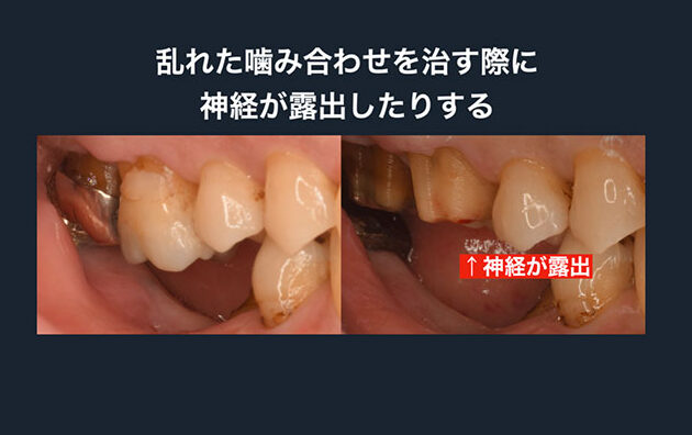 部分入れ歯を薄くする方法とメリット一覧